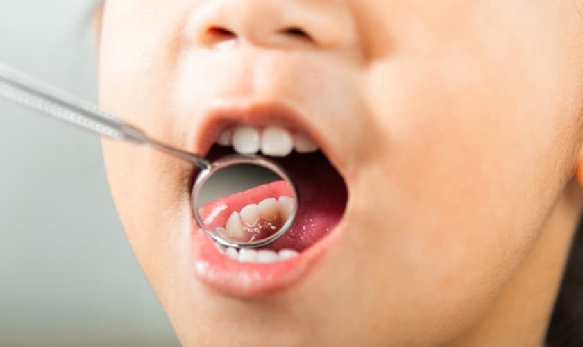 how to find and treat a cavity between two teeth of your kid