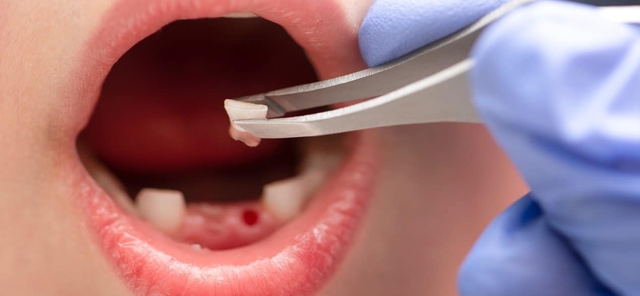 why delayed tooth shedding matters and how to identify potential issues