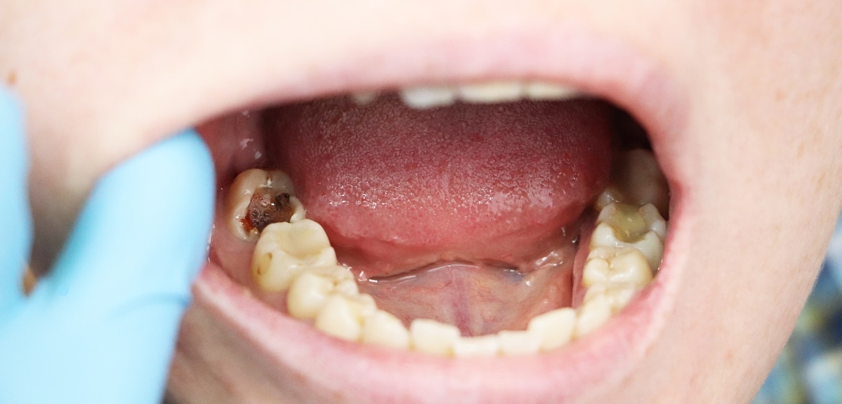 children teeth need care to protect them from cavities