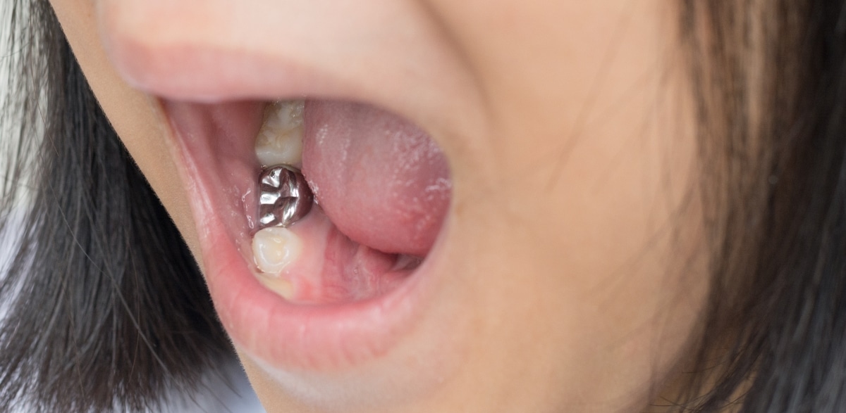 What to do if your child loses a dental crown